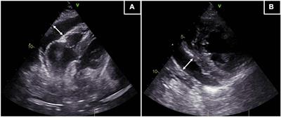 Multicolor flow cytometry on pericardial effusion for a prompt diagnosis and treatment of hematological malignancies with heart involvement